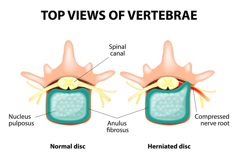 Sano und Hernia Intervertebral Disc
