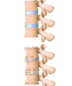 Die Ursachen der Osteochondose