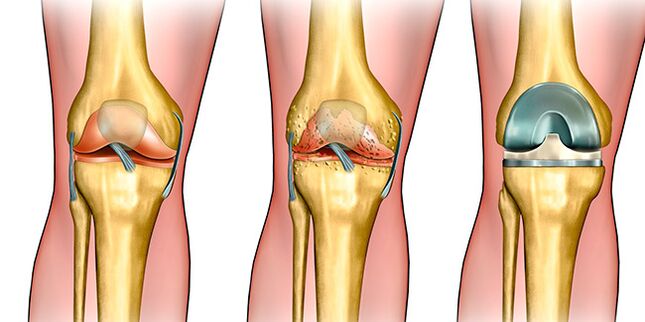 Im dritten Stadium der Arthrose ist ein Kniegelenkersatz notwendig